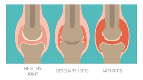 Rheumatoid Arthritis and Osteoarthritis: What is Common and How They Differ from Each Other ...