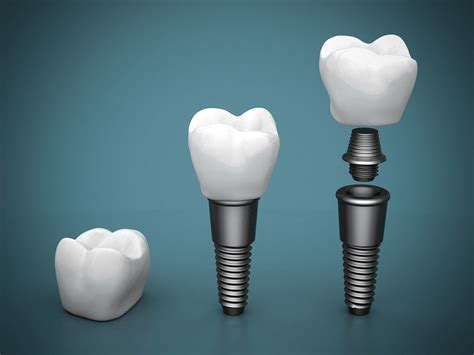 Different Types of Dental Implants