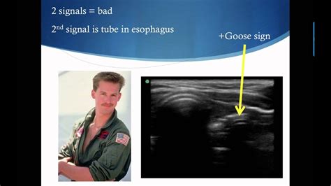 Intubation Endotracheal Tube Placement