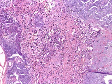 Pathology Outlines - Phosphaturic mesenchymal tumor