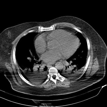 Beam hardening | Radiology Reference Article | Radiopaedia.org