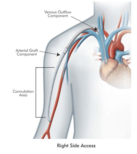 HeRO® Graft - Differs from Conventional AV Grafts