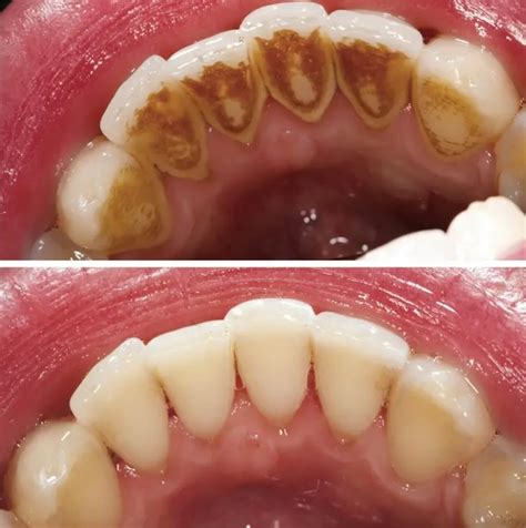 Teeth scaling procedure results before and after