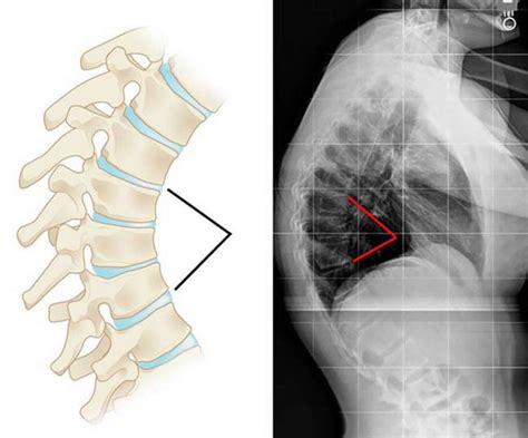 Scheuermann's disease causes, symptoms, diagnosis, treatment & prognosis