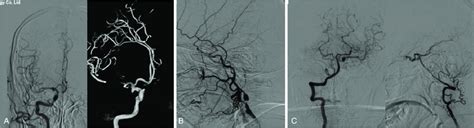 Carotid angiogram of the patient. (A) Right carotid angiography... | Download Scientific Diagram