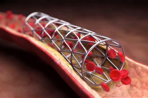 Best Coronary Stents from the Top Brands - iData Research