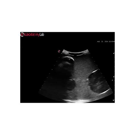 Abscess Drainage Ultrasound Training Block