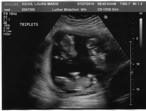 Hicks Triplets: ultrasound pics