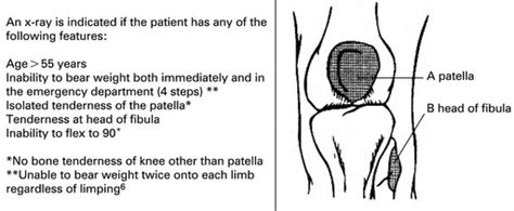 Ottawa Foot, Ankle and Knee rules - Mnemonic | Epomedicine