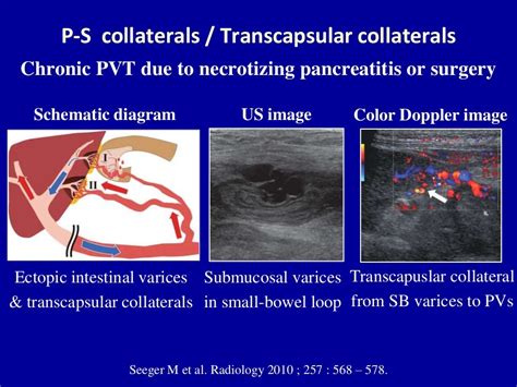 Doppler ultrasound of portal vein thrombosis