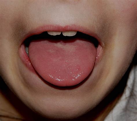 geographic tongue pic - pictures, photos