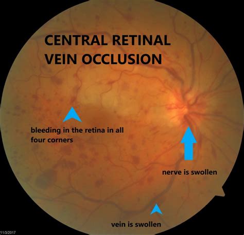 Vein Occlusion: What Is It? | SK Retina Specialist in Sarasota