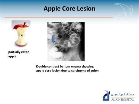 Food signs in radiology pp ta