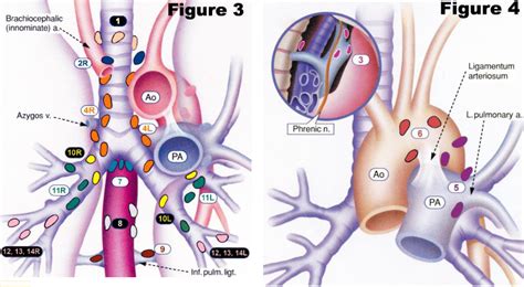 Lung Cancer Lymph Nodes