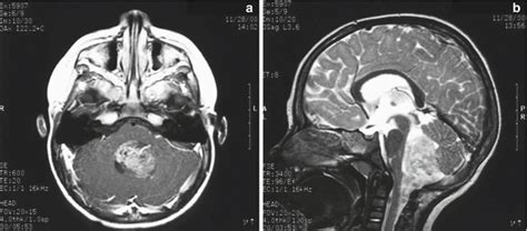 Ependymoma | Oncohema Key