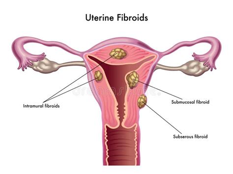 Soorten Baarmoederfibroids Endometriosis Infographics Vector Illustratie Die Op Witte ...