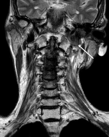 Recurrent syncope in head and neck cancer: a case report with ...