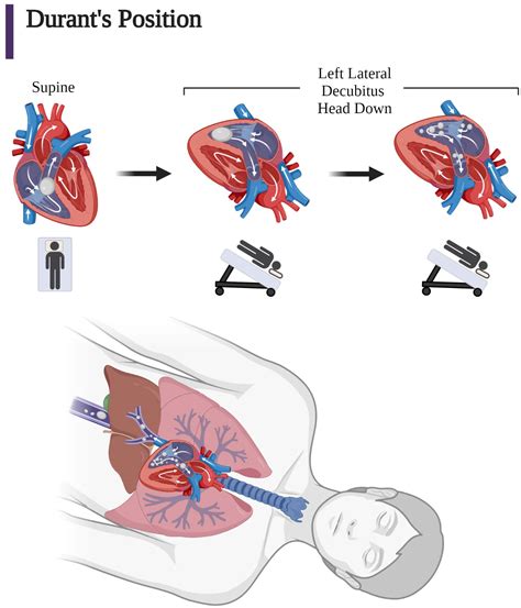 Trendelenburg Position For Air Embolism