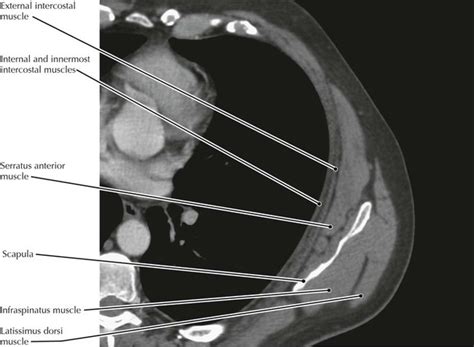 Upper Thigh Muscles Ct Anatomy Chest Anatomy Mri Chest Thorax | Images and Photos finder