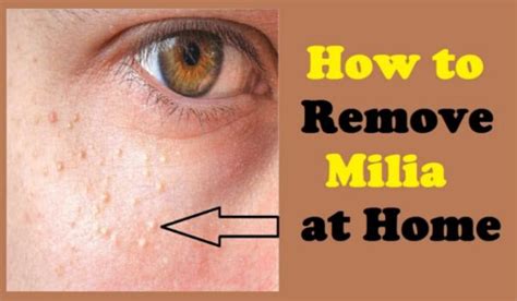 How to Get Rid of Milia At Home Easily » Right Home Remedies