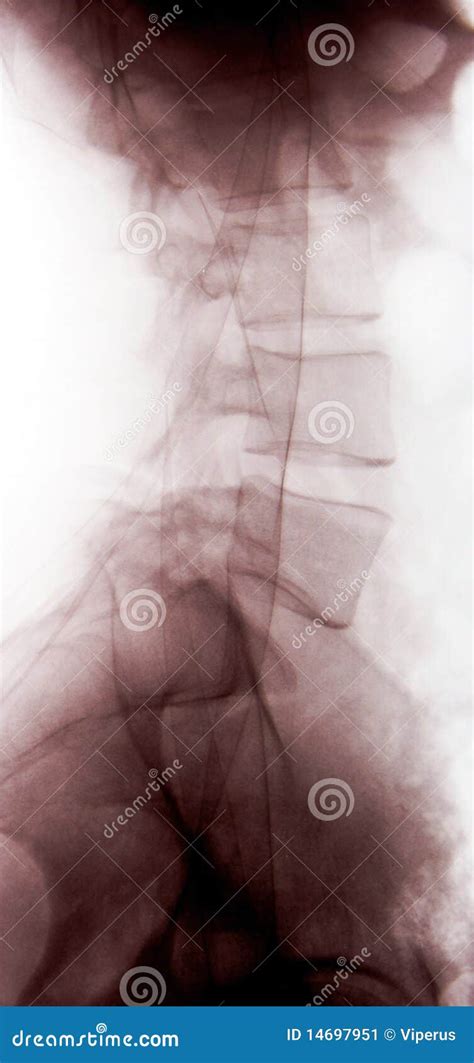 X-ray Of Lumbar Vertebrae Royalty-Free Stock Photo | CartoonDealer.com #14697951