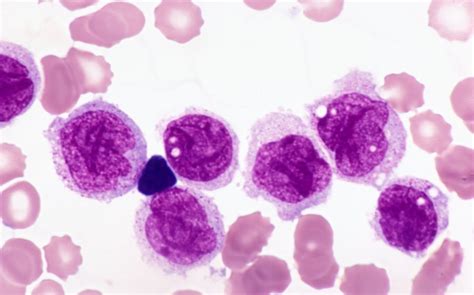 Leukemia, Monocytic, Acute; Leukemia, Monoblastic, Acute; Leukemia, Myeloid, Acute, M5; Leukemia ...