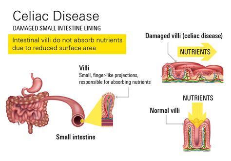 Celiac Disease