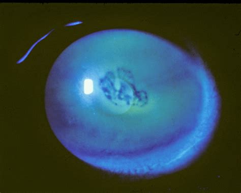 The Patient's Guide to Recurrent Corneal Erosion - Eyedolatry