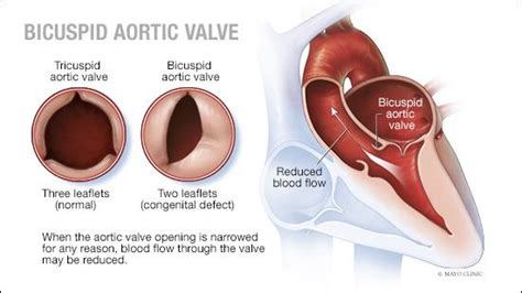 Mayo Clinic Q and A: What is a bicuspid aortic valve? - Mayo Clinic News Network