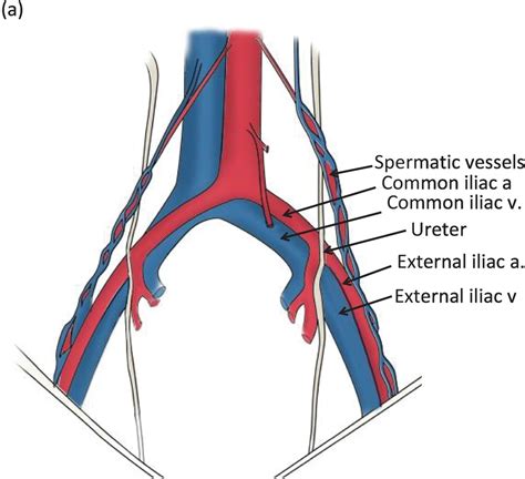 ⭐ Common iliac. Common iliac artery: Anatomy, branches, supply. 2022-10-03