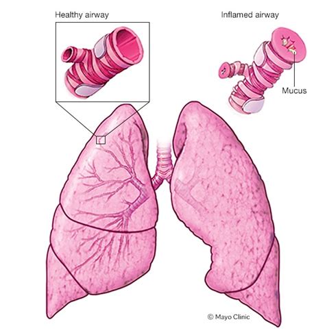 Asthma - Symptoms and causes - Mayo Clinic