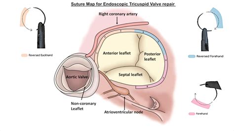 Suture map for endoscopic tricuspid valve repair | MMCTS