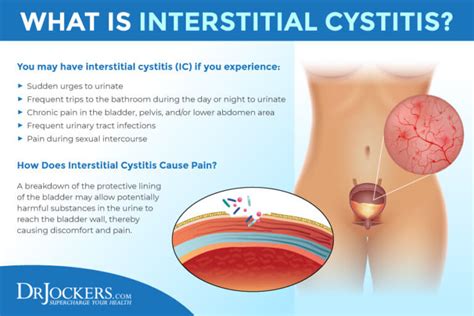 Interstitial Cystitis: Symptoms, Causes and Support Strategies