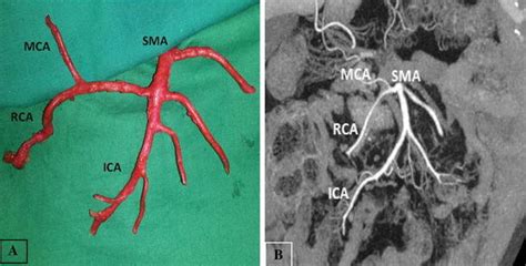 Pattern II.a: Common trunk of the middle colic artery and right colic... | Download Scientific ...