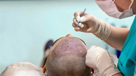 How Much Does Hair Transplant Cost In Hyderabad Madhapur - Cyber Hairsure