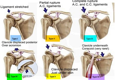 Separated Shoulder - Causes, Symptoms, Exercises, Treatment