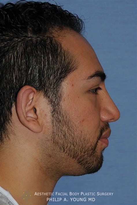 Macrotia Large Ear Reduction Prominent Ear Pinning Otoplasty