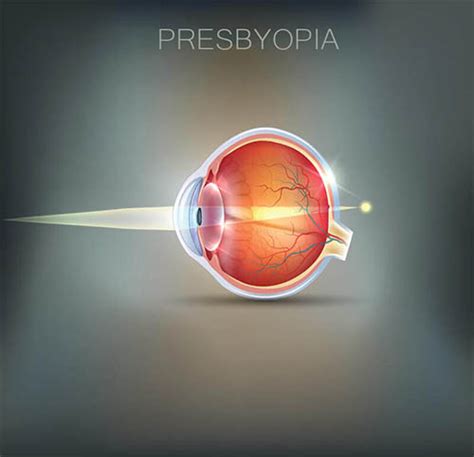 Presbyopia | Pacific Eye Surgeons | Eye Care San Luis Obispo