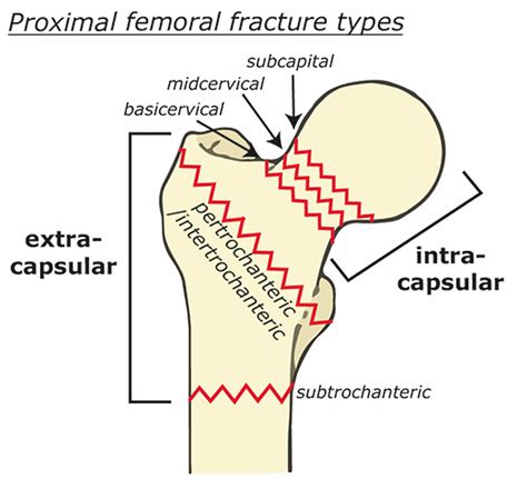 Femoral neck fracture causes, types, symptoms, diagnosis, treatment ...