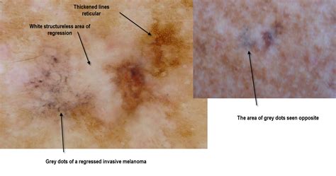 Dermoscopy Made Simple: Melanoma in situ mainly