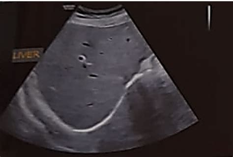 USG scan of the patient showing mild hepatomegaly | Download Scientific Diagram