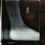 Bilateral Femur Fractures – Part 1 – Disaster-RX