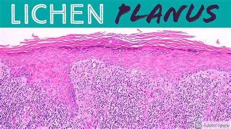 Lichen Planus Histology