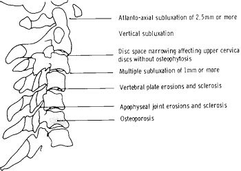 Rheumatoid Neck Disorders - Rheumatoid Arthritis Neck