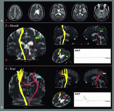 (A) T2-weighted images (2 mo after onset) showing an infarct in the... | Download Scientific Diagram