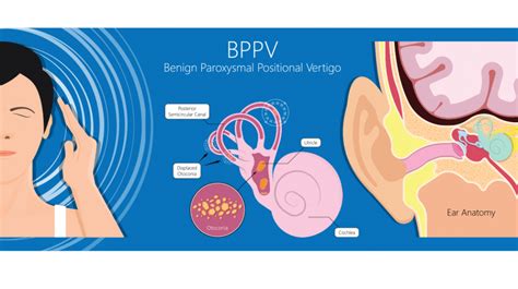 Balance & Vestibular Rehab - BPPV • Rising Tide Physical Therapy