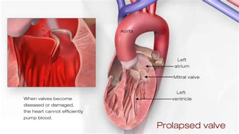 What is mitral valve disease?