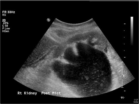 Persisting hydronephrosis on ultrasound with debris. | Download ...