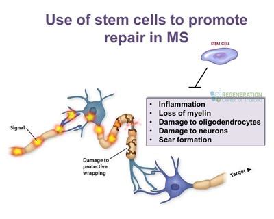 Stem Cell Treatment for Multiple Sclerosis - MS PLS HSCT