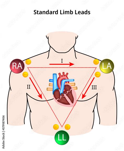 Standard Limb Leads ECG - Einthoven Triangle - Electrocardiogram - Medical Vector Illustration ...